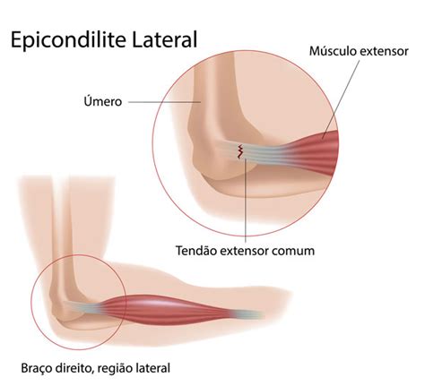 Epicondilite Lateral Cotovelo Do Tenista ICOTE