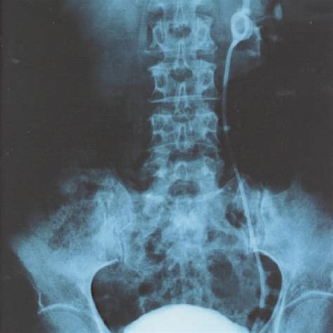 Pdf Noninvasive Assessment Of Patency Of Internal Ureteral Stent