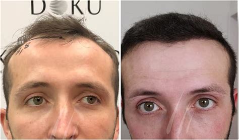 Haartransplantation T Rkei Besten Kliniken In Istanbul