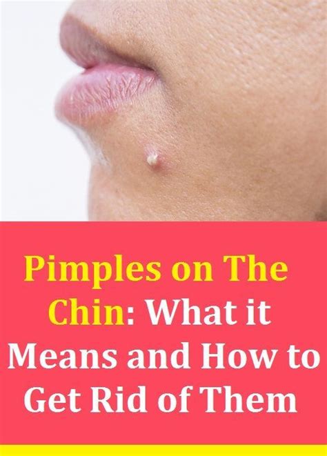 Pimples On The Chin What It Means And How To Get Rid Of Them Pimples Proper Skin Care