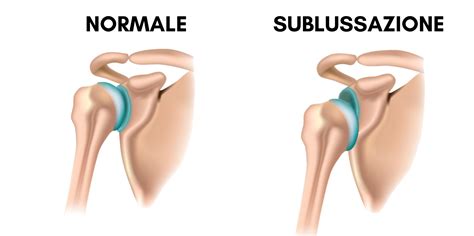 Sublussazione Della Spalla Ecco Cosa Fare Sintomi E Cura