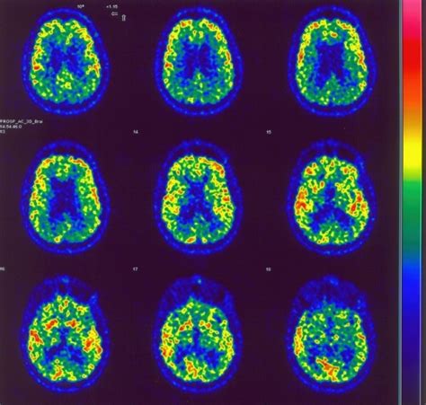 NeuroBlog+: Anoxia cerebral