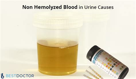 Non Hemolyzed Blood in Urine Causes | Hematuria Causes During Pregnancy