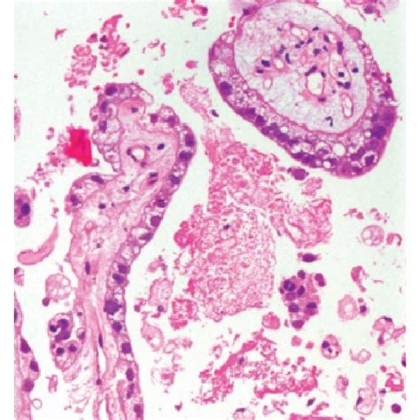 A Gastric Adenocarcinoma Papillary Growth Pattern B Gastric Tumor Download Scientific