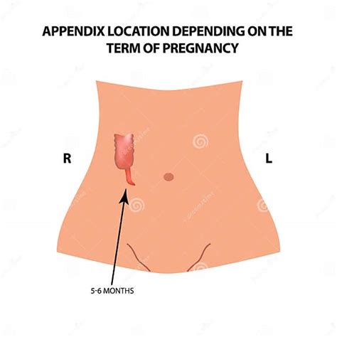 The Location Of The Appendix Depends On The Term Of Pregnancy 5 6 Months Infographics Stock