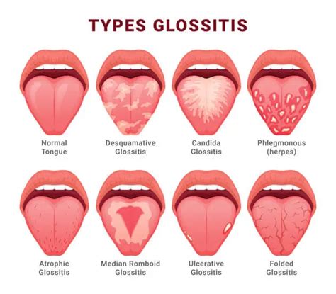 Glossitis: Causes, Symptoms, Diagnosis, and Treatment