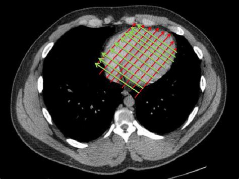 An Oblique Reconstruction Of A Ct Scan Mpr Of The Heart According To