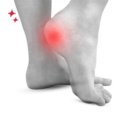 Plantar Fasciitis Lo Physio