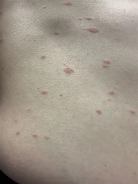 Spots Popped Up About A Week Ago Doesnt Itch Or Peel Flake Possible