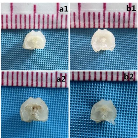 Cross-sectional observation: axial image of the femoral trochlea: a1 5 ...