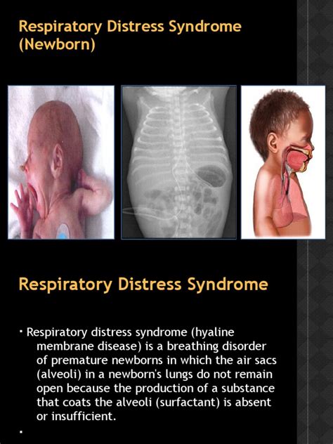 Respiratory Distress Syndrome (Newborn) | Breathing | Lung