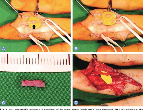 Figure 4 From Treatment Of The Traumatic Neuroma Semantic Scholar