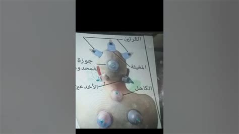 الأماكن المناسبة في الجسم التي يمكن عمل الحجامة عليها للعلاج من بعض