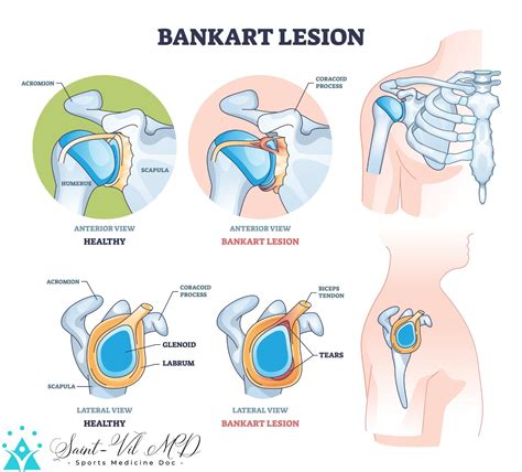 Bankart Lesion As Anterior Part Of The Glenoid Labrum Trauma Outline