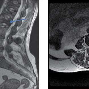 A Sagittal T Weighted Sequence Of The Thoracic And Lumbar Spine Shows