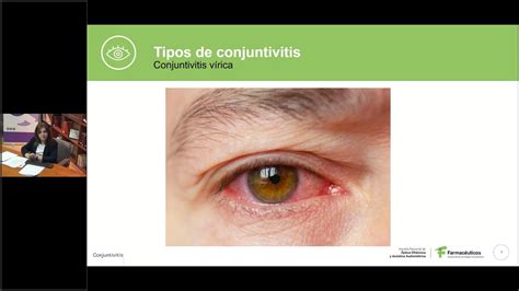 Webinar “conjuntivitis Consejos Desde La Farmacia Comunitaria” Youtube