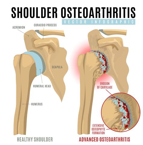 The Ultimate Cheat Sheet On Shoulder Injuries