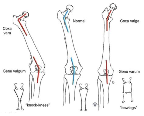 Condition Spotlight Genu Varum And Genu Valgum Watsonia Podiatry