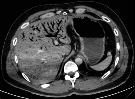 Computed Tomography Scan Showed Gas Filling The Portal System