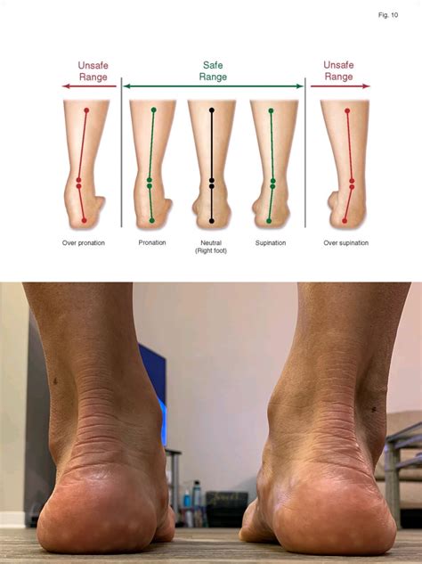 Supination Foot Biomechanics Explained Types Causes Treatment