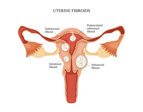 Miom Penyebab Gejala Diagnosis Pengobatan