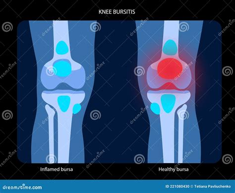 Knee Bursitissuperficial Infrapatellar Bursitis Cartoon Vector