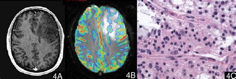 A Case Of Oligodendroglioma Who Grade Ii A Postcontrast