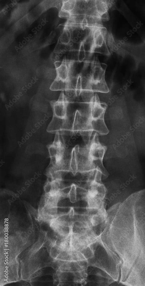 X-Ray of the Spine Stock Photo | Adobe Stock