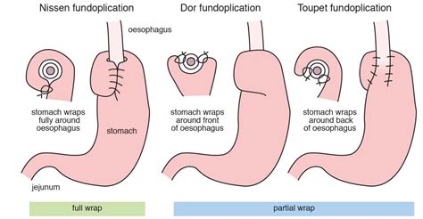 Fundoplication Tofs Oatof Support