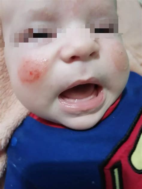Сыпь на лице у ребенка Ребёнку 1 месяц и 7 дней . Появилась сыпь на ...