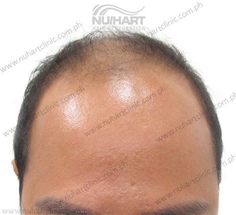 Final Before And After Sliding1aaa Nuhart Hair Restoration Philippines