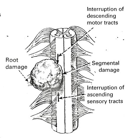 Lumbar Spinal Nerve Compression And Lower Limb Peripheral Nerve Injury