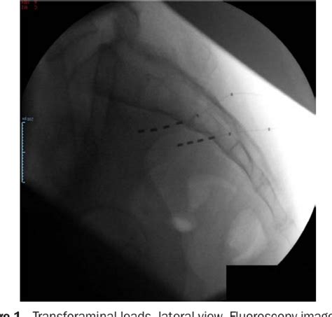 Figure 1 From Transforaminal Sacral Nerve Neurostimulation For The Treatment Of Intractable