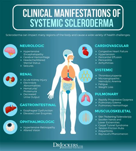 Scleroderma Causes Symptoms And Natural Support Strategies