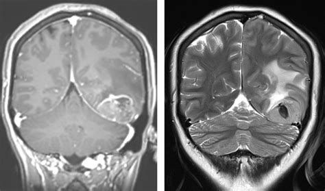 Anaplastic astrocytoma – Radiology Cases