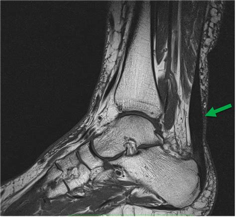 Arthroskopie Am Fuss Und Sprunggelenk Fusschirurgie Z Rich Prof Dr