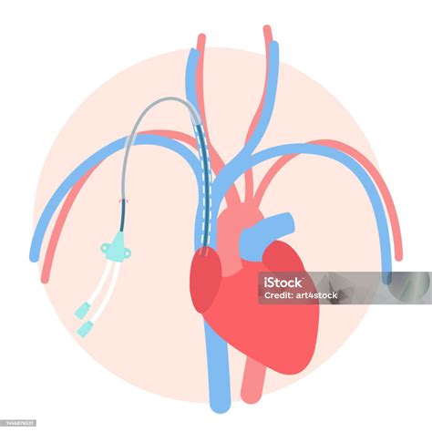 Tunneled Central Line Venous Catheter Medical Diagram Stock