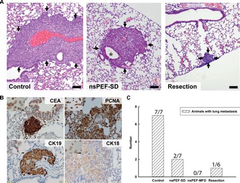 Lung Metastases Examined In HCCLM3 Implanted Nude Mice A Metastatic