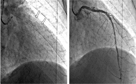 D) Conventional angiography of the LAD showing faint stent struts ...