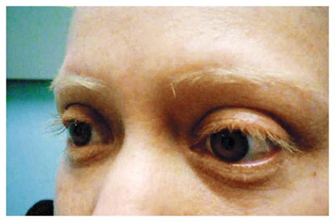 Horizontal Pendular Nystagmus In A Patient With Ocular Albinism NEJM