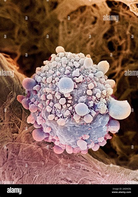 Pancreatic Cancer Cell Coloured Scanning Electron Micrograph Sem Of A Pancreatic Cancer Cell