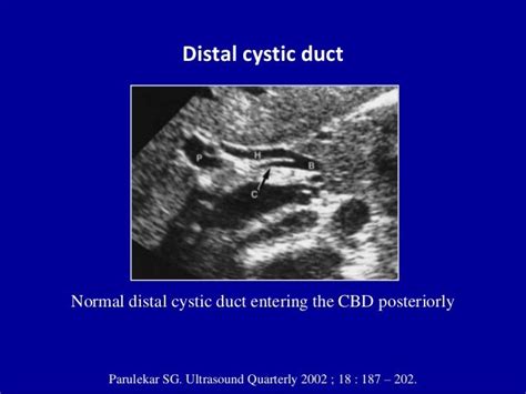 Cystic Duct Ultrasound