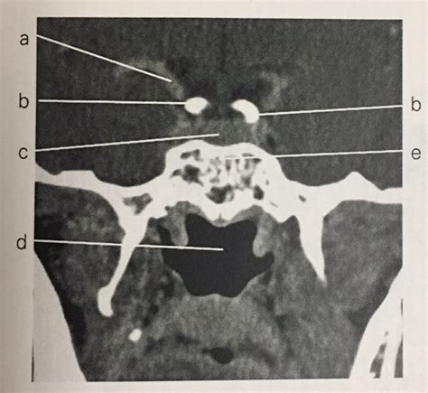 Ct Coronal Recon Of Temporal Bones Diagram Quizlet