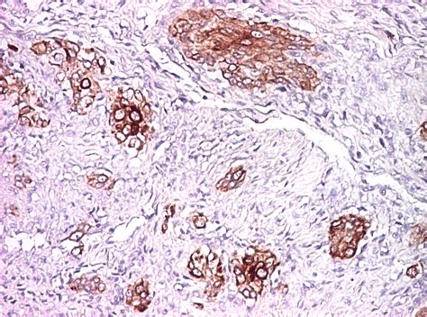 Diffuse And Intense Ck Positivity In Tumor Cells Ihc Staining