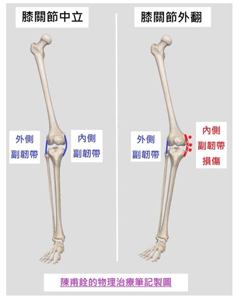 膝蓋的內側副韌帶 受傷了，該怎麼辦呢？ 陳甫銓的物理治療筆記 2022 年 5 月 26 日