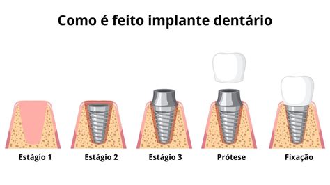 Implante dentário veja se dói resultados tempo e valores