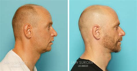 Jaw Removal