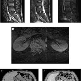 A Sagittal T2 Weighted Magnetic Resonance MR Image 3 Months