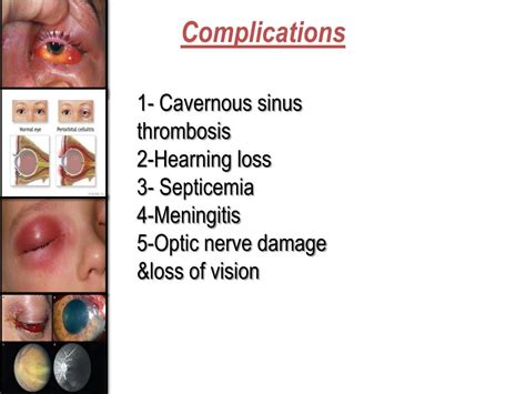 PPT - Orbital cellulitis PowerPoint Presentation, free download - ID ...