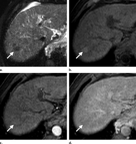 High Grade Dysplastic Nodule Or Early HCC In A 46 Year Old Man With